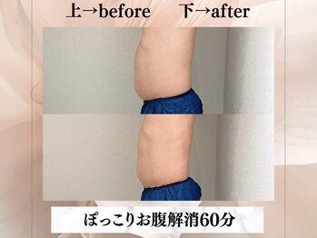 イヨヨ(iyoyo)/【痩身】Before After