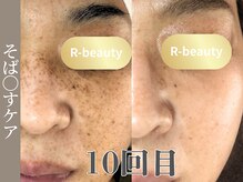 アールビューティー(R-beauty)/顔全体に広がる細かいシミ改善