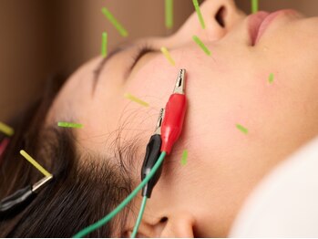 ハル(HARU)の写真/美容鍼で顔の内側にアプローチ♪むくみやこりを解消して、リフトアップした理想のすっきり小顔へ★