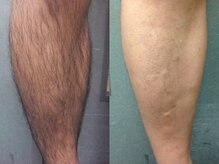 エミュ(emu formen)/見えるところの毛はなくそう