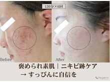レガロビューティクリエイションズ桜川店/褒められ素肌│ニキビケア