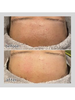 アデル 久留米(ADEL)/《全顔》おでこワックス