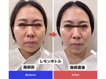 エトワール(etoile)/施術直後に驚きの大変化！