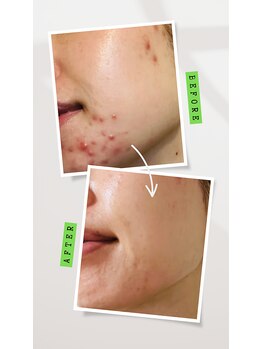 リマイン(Re mine)/ニキビ改善大得意 VOSサロンケア