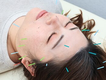 ザワ鍼灸接骨院(zawa鍼灸接骨院)の写真/美容鍼でお顔の筋肉にアプローチしていくので、小顔・リフトアップの効果が期待大♪お気軽に来店ください☆