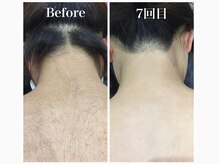ハダハダ(HADA HADA Medical Esthetic)/どんな細い産毛もお任せ下さい♪