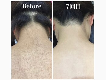 ハダハダ(HADA HADA Medical Esthetic)/どんな細い産毛もお任せ下さい♪