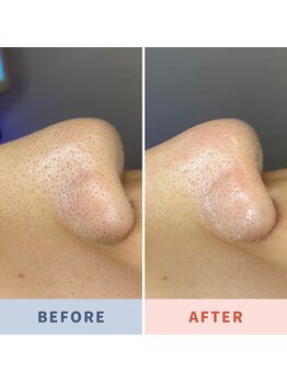 ソリス ビューティー(SOLIS BEAUTY)/毛穴洗浄