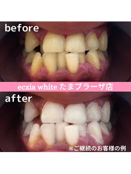 エクシアホワイトニング たまプラーザ店/ビフォーアフター