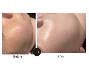 フォビィサロン(FOBE...salon)/シミケア