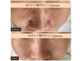 クトナ(Qutona)/黒ずみ毛穴【４ヶ月後の変化】