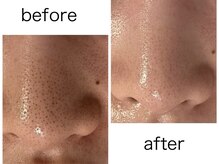 ルシェリア(Lecherien)/超音波毛穴洗浄＆角栓吸引