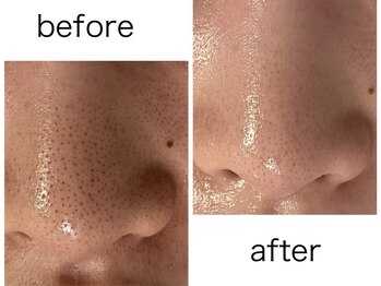 ルシェリア(Lecherien)/超音波毛穴洗浄＆角栓吸引