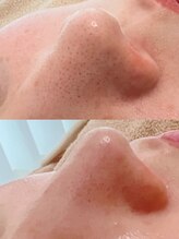 フェリノ(FERINO)/毛穴洗浄でツルツルに☆