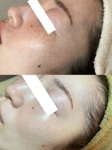 ナトゥーラ(NatuLa)/シミケアトリートメント