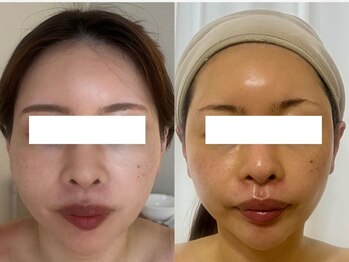 ブルーム(BLOOM)/４か月後/月に一度のWISHｐro