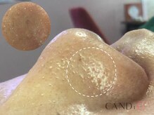 キャンディ 天王寺(CANDi)/ハイドラピーリング黒ずみ毛穴◎