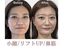ラプリ 札幌ル・トロワ店/隆鼻＋輪郭矯正40分　10回
