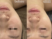 サロンワイアネシス(Salon y ANESIS)/ハーブピーリング4回の変化