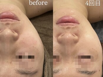 サロンワイアネシス(Salon y ANESIS)/ハーブピーリング4回の変化