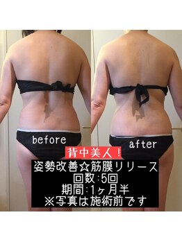 リエンシン(Riensin)/筋膜リリース/before after