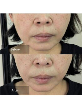 マインドール/顔全体のむくみ改善でスッキリ