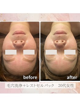 エソール(essor)/毛穴洗浄×レストセルで叶う艶肌