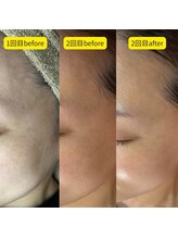 メイト(mate)/エクソソームハーブピーリング