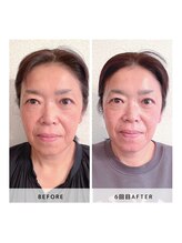 サロン レインボー(SALON RAINBOW)/小顔集中コース　Before/After