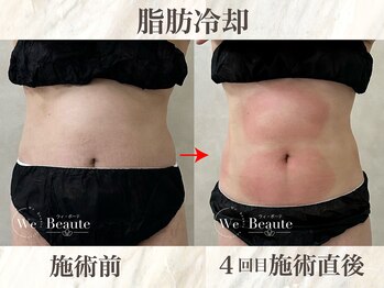 ウィボーテ(We Beaute)/【痩身】脂肪冷却×脂肪分解