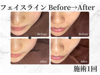 セレーノ 白金台(seReno)/サーマ×ララピールBeforeAfter