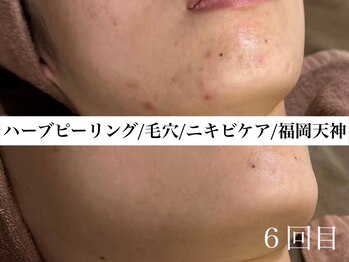 ホワイトアクア 福岡天神店(WHITE AQUA)/ハーブピーリングビフォー