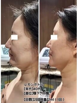 ソルドット(Sol.)/話題の脂肪分解レモンボトル