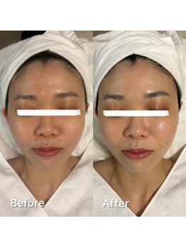 デディア 恵比寿(dedia)/肌荒れ→レチノールで健康的な肌