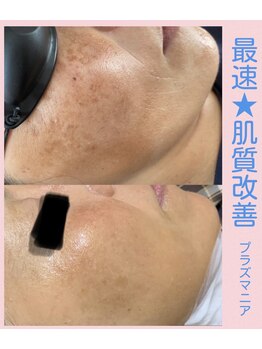 ミラビューティー(Mira Beauty)の写真/シミ・くすみ・毛穴のお悩みに◎無料肌診断付きプラズマ肌管理