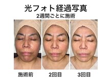 猫の手の雰囲気（諦めてた40代50代のシミを改善！光フェイシャルで輝く透明美肌へ）
