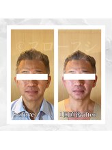 フローフシ∞/【小顔】40代男性症例写真