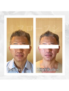フローフシ∞/【小顔】40代男性症例写真