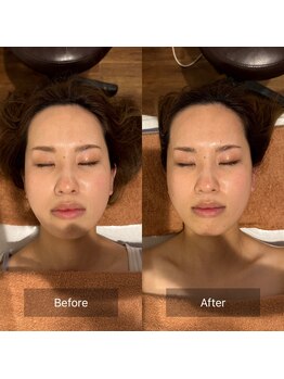 フフラ KANコルギセラピー山梨本店(fufla)/【頭皮筋膜リフト+3D小顔】