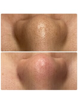 シャルム(Charme)/毛穴肌質改善コース