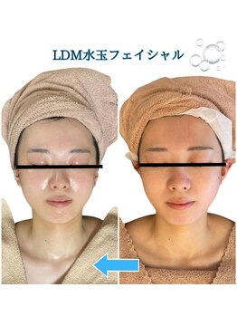 コーラル(Coral)/ldm施術結果