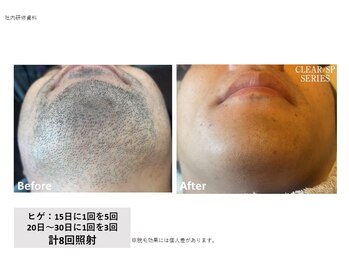 目が美きゅっと/ヒゲ脱毛