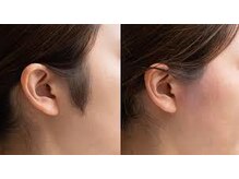 シュガーリングハウスレディ(SugaringHouse LADY)/もみあげシュガーリング