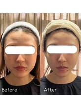 ジジベレッザ 大阪中崎町店(jiji belleza) 人気No.3 小顔美肌