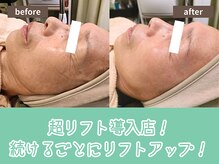 キザシ(kizashi)/最新機器超リフトでツヤ肌