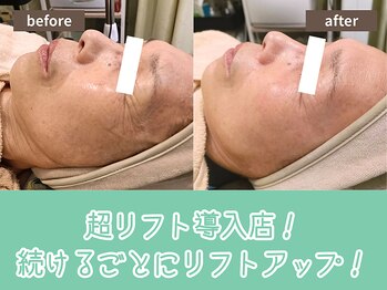 キザシ(kizashi)/最新機器超リフトでツヤ肌