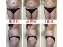 スズ(SUZU)の雰囲気(半永久*お腹脂肪分解痩身)