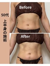 タノソイネ(tanosoine)/【50代/ハイパーナイフ痩身】