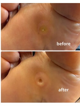 シュガーズネイル(sugar's nail)/魚の目ケア