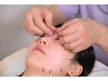 かつらはりきゅう 小児しん/必要な場所に必要な数の美容鍼